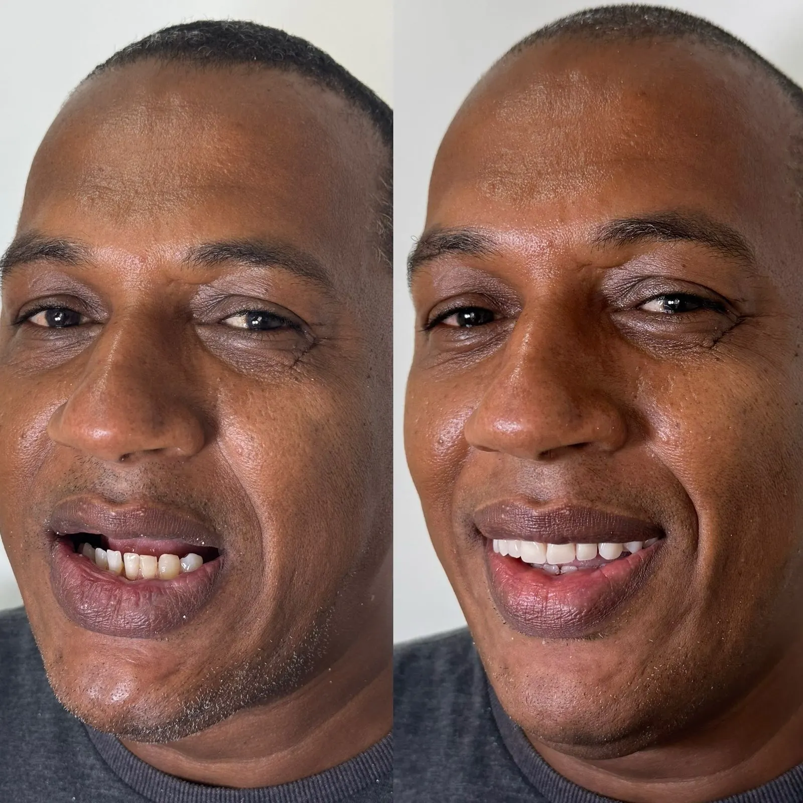 Comparação antes e depois do sorriso de um paciente após reabilitação oral