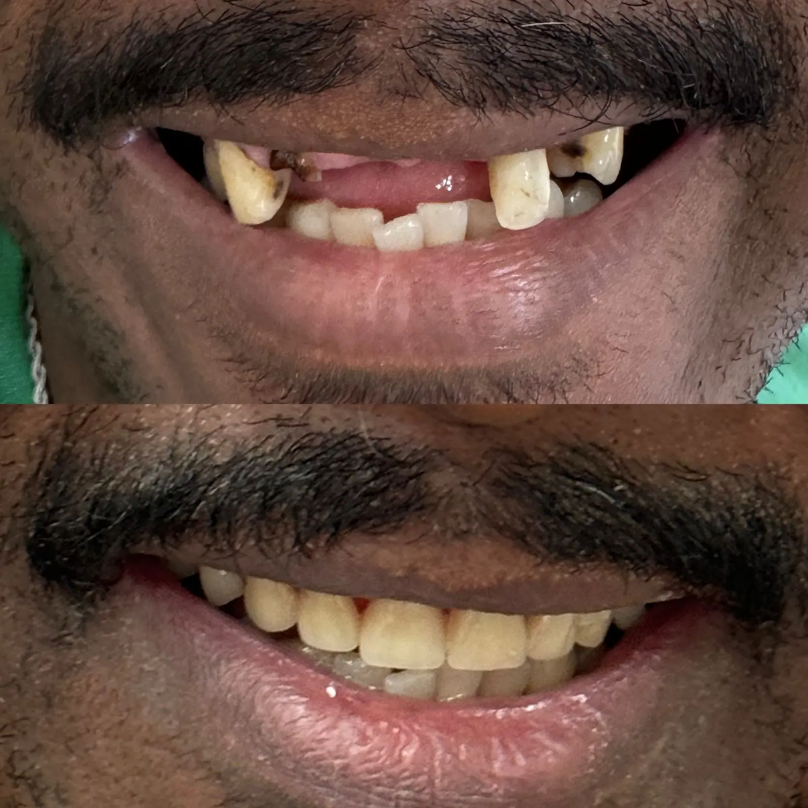 Registro comparativo do sorriso de um paciente antes e depois do tratamento