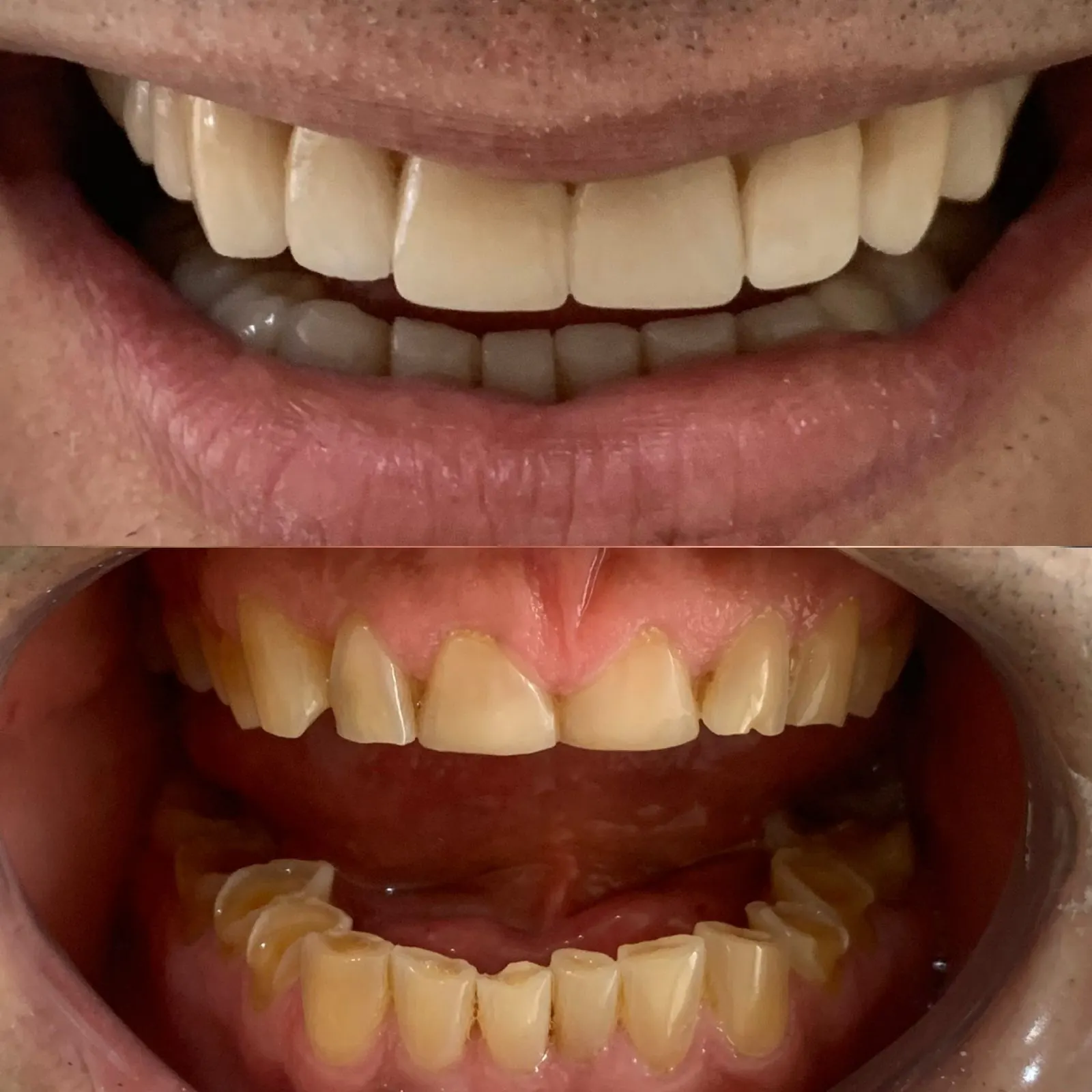Comparativo clínico dos dentes de um paciente em dois momentos do tratamento