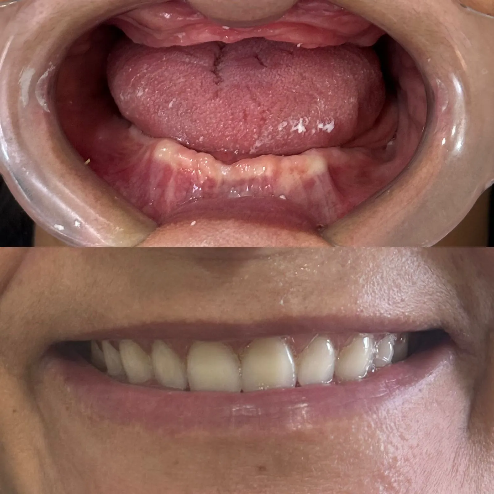 Registro do sorriso de um paciente antes e depois da reabilitação oral