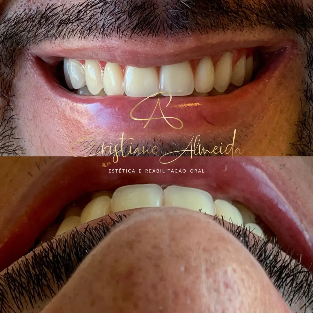 Detalhe final do sorriso de um paciente após a reabilitação oral
