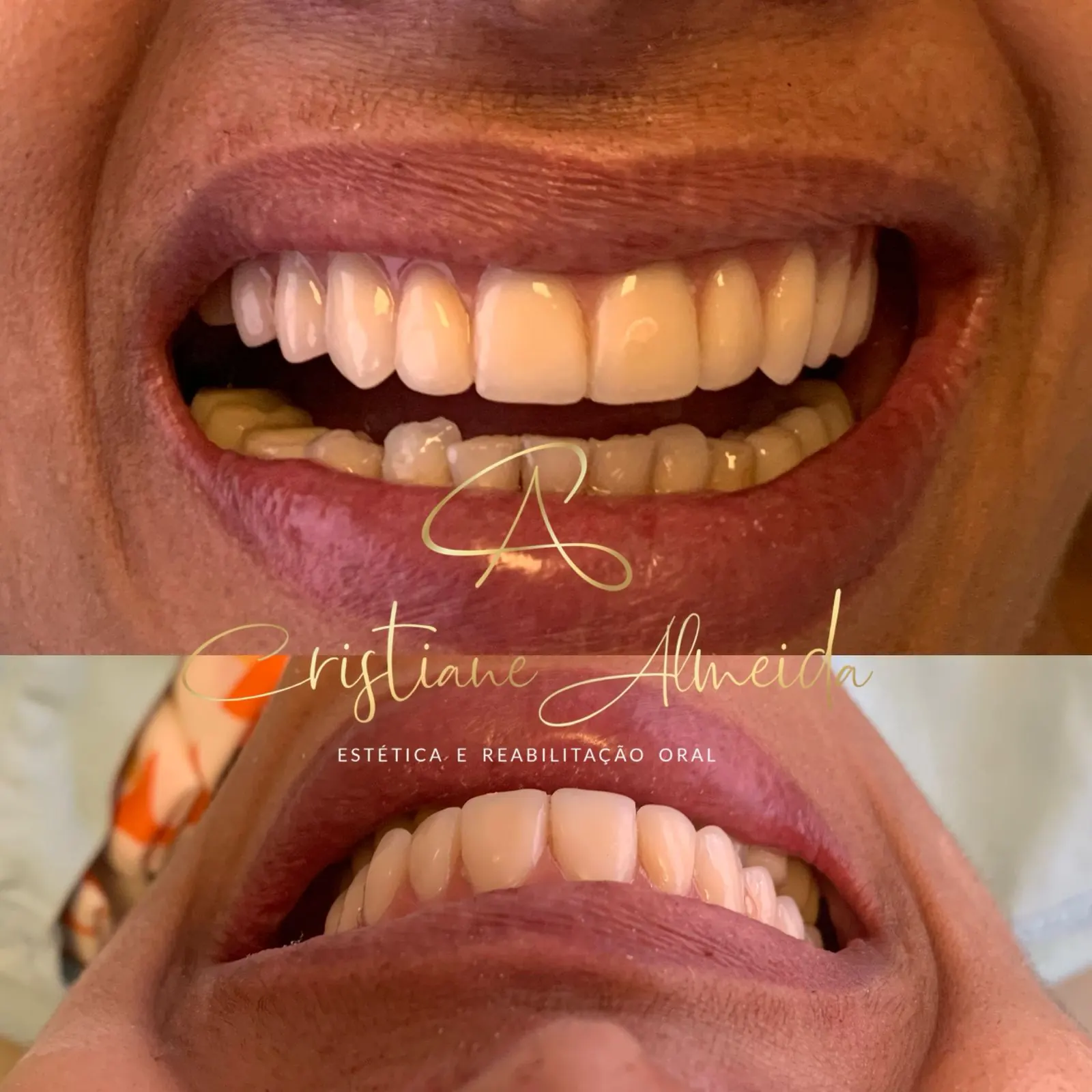 Comparativo do sorriso de um paciente antes e depois do tratamento