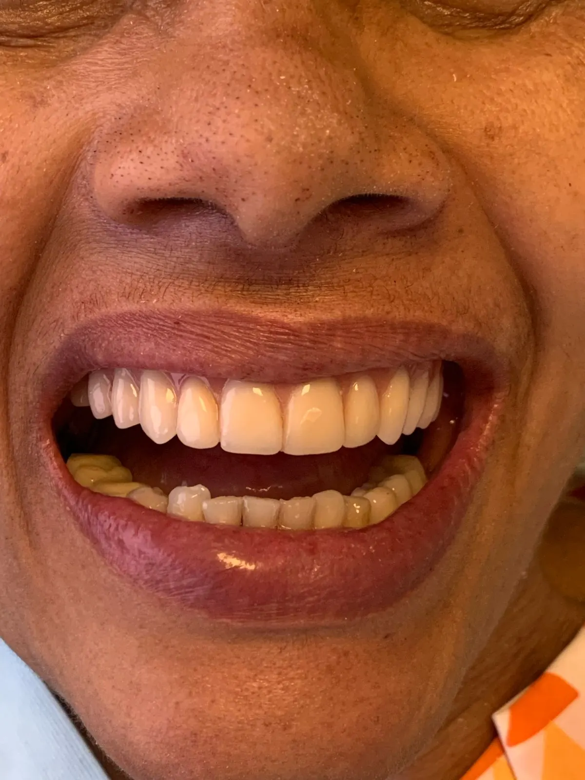 Sorriso de uma paciente em detalhe após a conclusão do tratamento