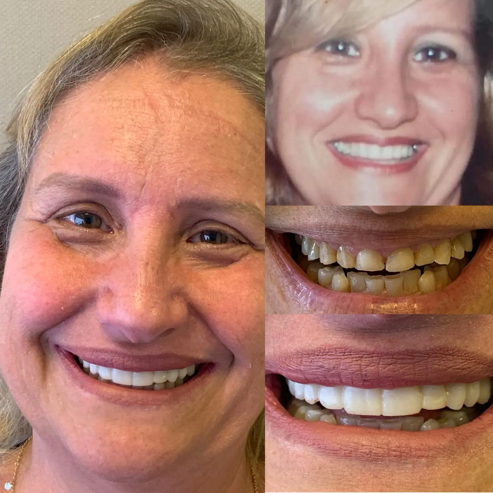 Comparativo do rosto e do sorriso de um paciente antes e depois do tratamento